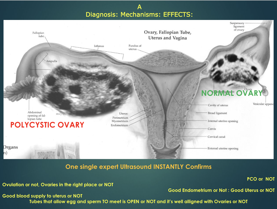 PCOS (Polycystic Ovary Syndrome) - Couples To Parents